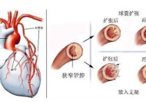 紅纓醫(yī)院治療冠心病怎么樣 北京治療冠心病最好的醫(yī)院是哪家?